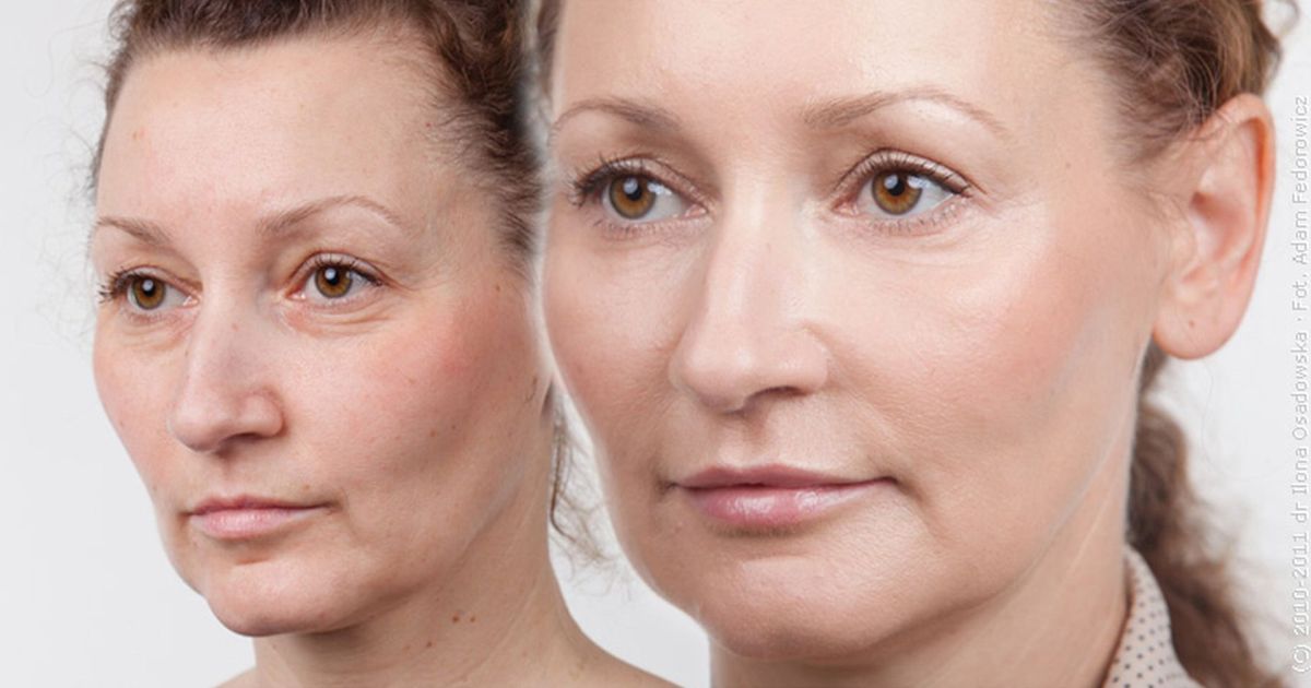 Radiesse – dlaczego działa jednocześnie jako wypełniacz i stymulator?